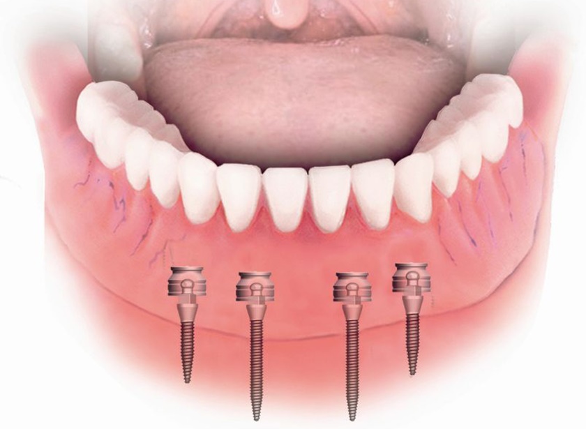 Mini Implant và Implant truyền thống